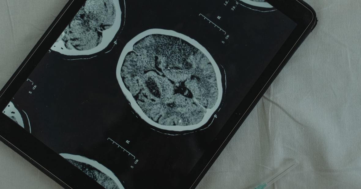 resonancia cerebral